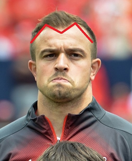 Xherdan Shaqiri's m-shaped hairline