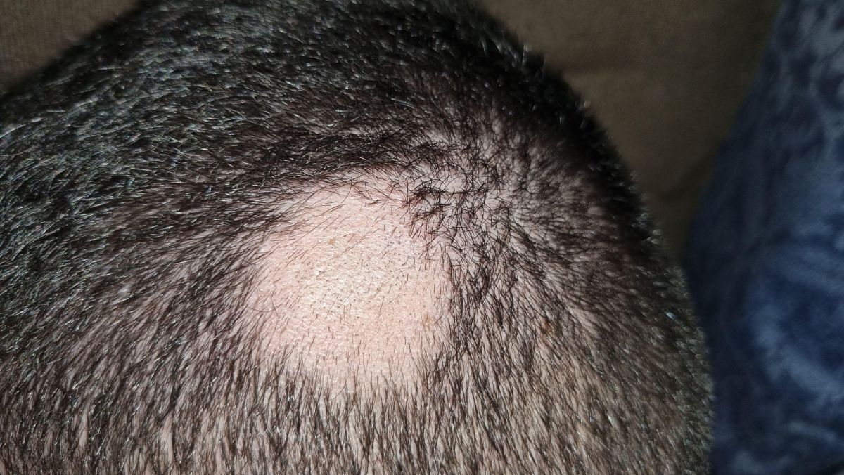 early stage alopecia areata