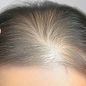 Can A Hair Transplant Treat Thinning Hair?