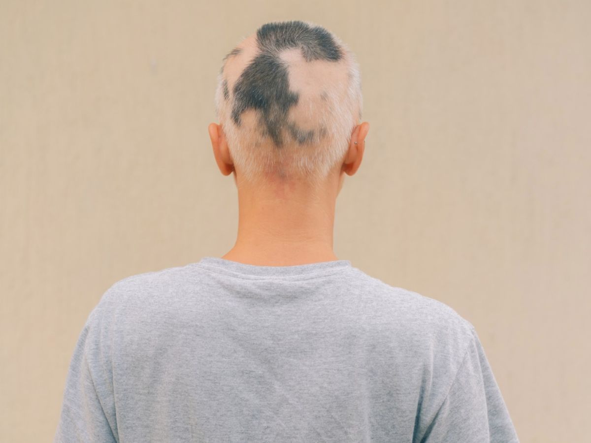 woman with alopecia areata