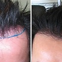 1000 Grafts Hair Transplant: Coverage, Costs, Results