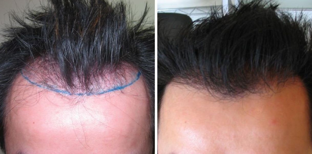 1000 Grafts Hair Transplant: Coverage, Costs, Results