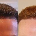 500 Grafts Hair Transplant: Coverage, Results, Costs