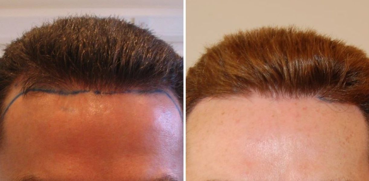 500 Grafts Hair Transplant: Coverage, Results, Costs