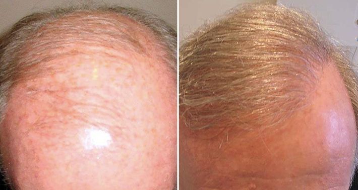 Before and 12 months after Norwood 6 hair transplant