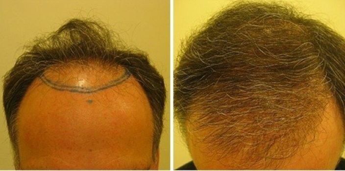 Before and 4 months after a hair transplant at the Wimpole Clinic