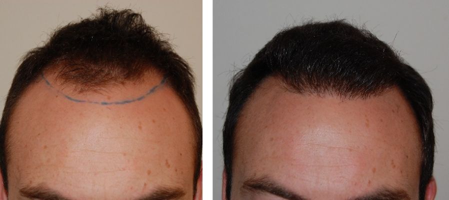 Before and 6 months after an FUE hair transplant