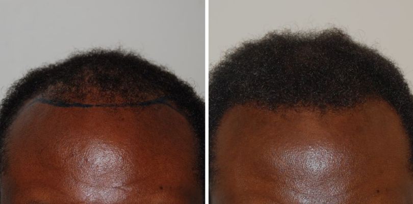 Before and 8 months after an Afro-textured hair transplant (FUT)