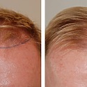 Hair Transplant After 4 Months: Photos, Results, Side Effects