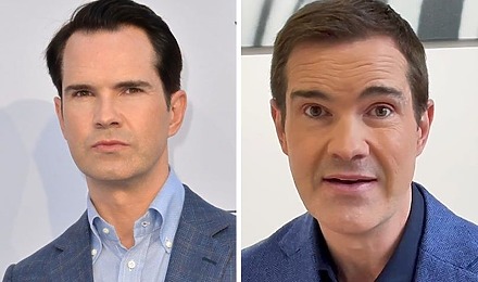 Jimmy Carr Hair Transplant