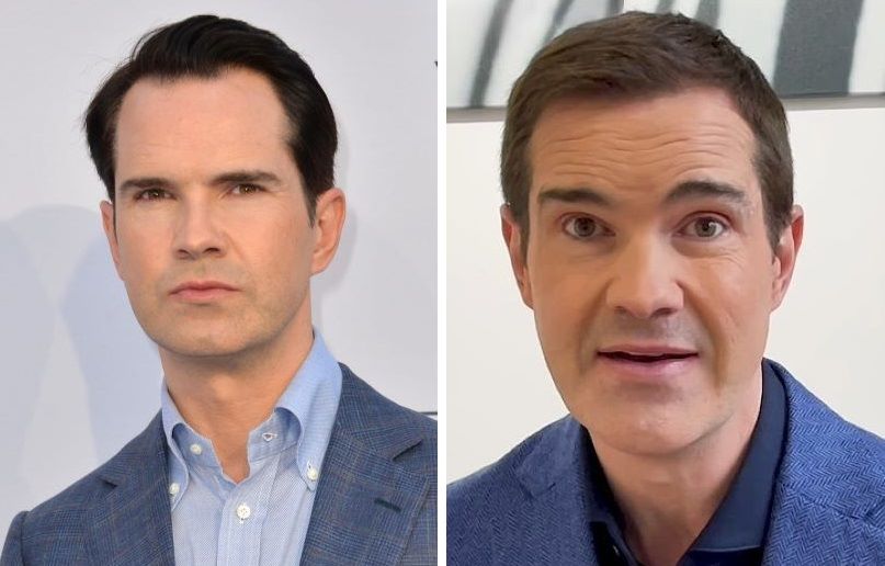 Jimmy Carr hair transplant