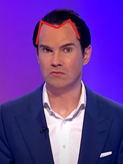 Jimmy Carr's m-shaped hairline