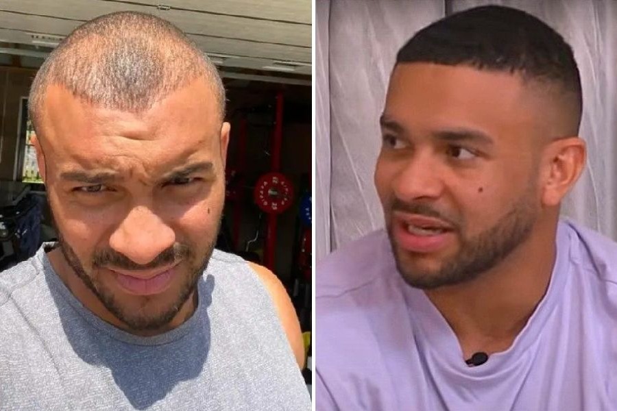 Jonathan Joseph Hair Transplant