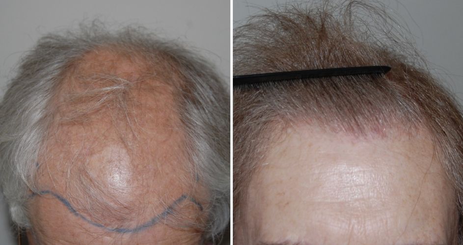 Norwood stage 6 patient before and after a 4100 graft hair transplant at the Wimpole Clinic