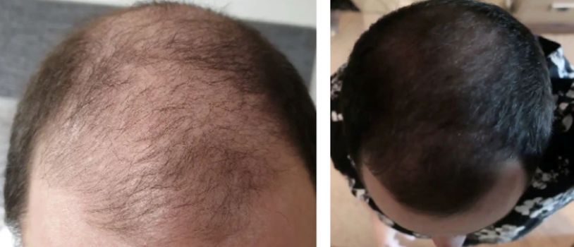 Patient before and after using medication to treat hair loss