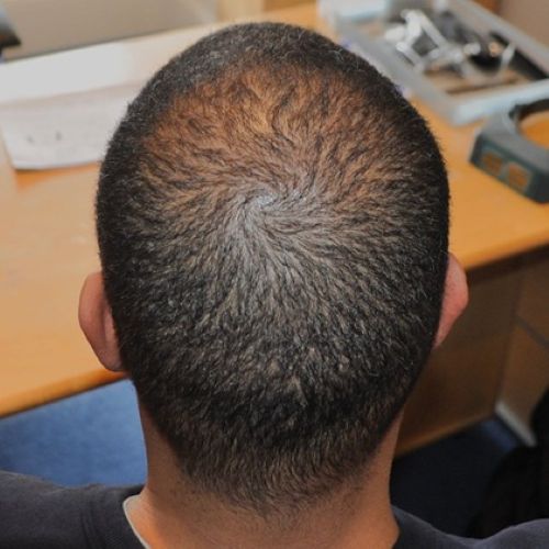Wimpole Clinic patient 14 months post-hair transplant