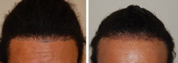 Wimpole Clinic patient before and 2 months after hair transplant