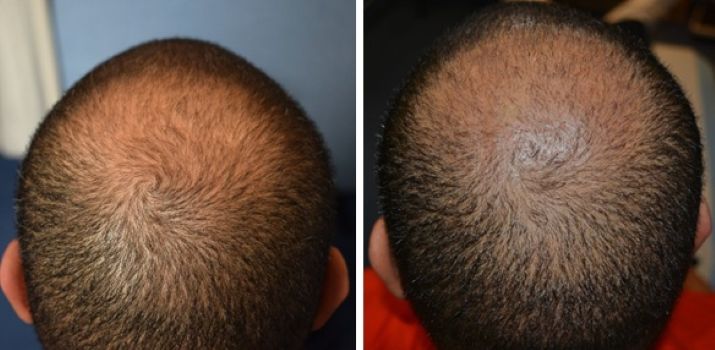 Wimpole Clinic patient before and 7 weeks after hair transplant