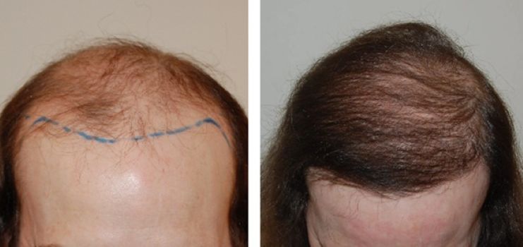 Wimpole patient before and 17 months after hair transplant