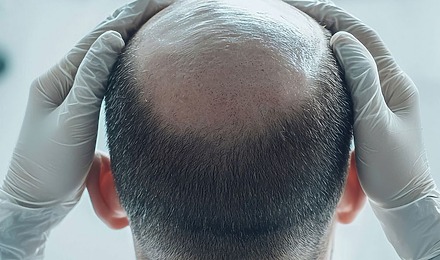 Crown Hair Transplant Cost