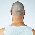 Retrograde Alopecia: Symptoms, Causes, Treatments