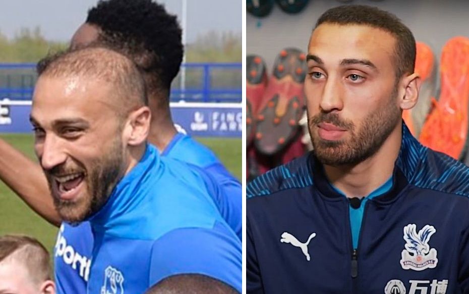 Cenk Tosun hair transplant