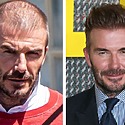 David Beckham Hair Transplant: Everything You Need To Know