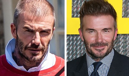 David Beckham Hair Transplant