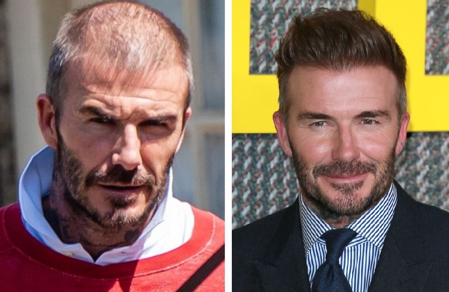 David Beckham hair transplant