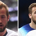 Harry Kane Hair Transplant: Everything You Need To Know