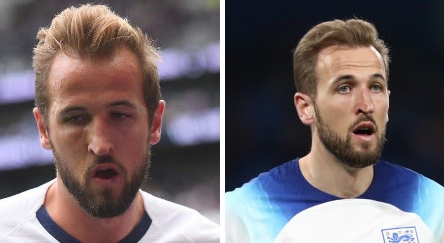 Harry Kane Hair Transplant