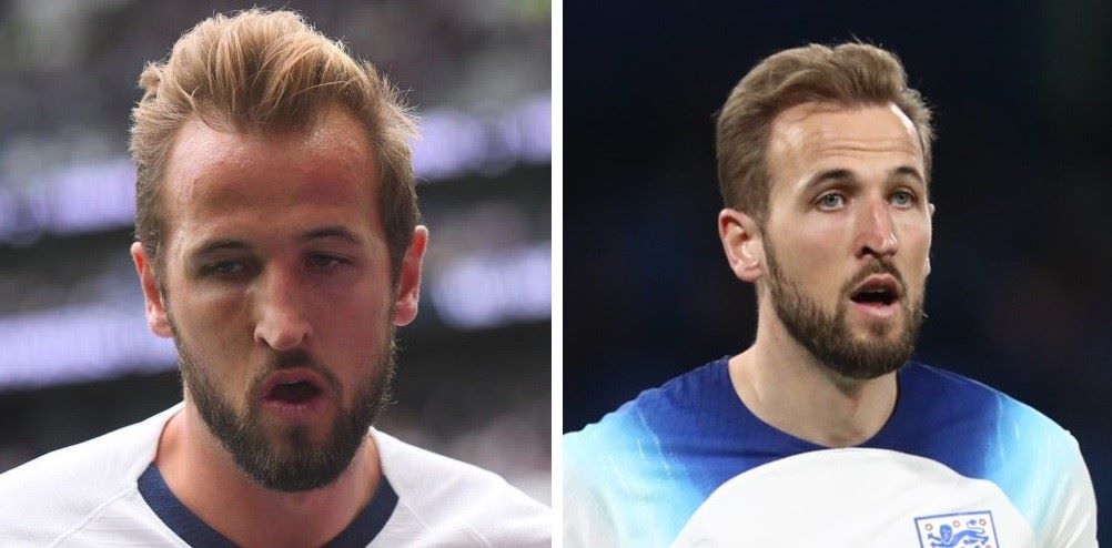 Harry Kane hair transplant