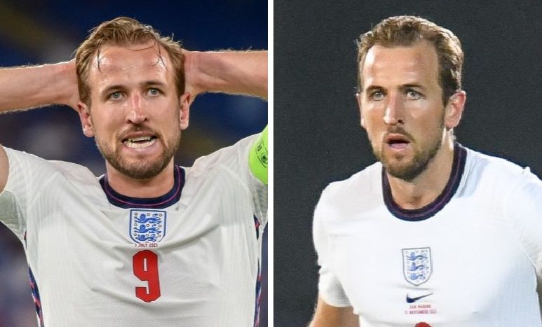 Harry Kane's hairline in 2021