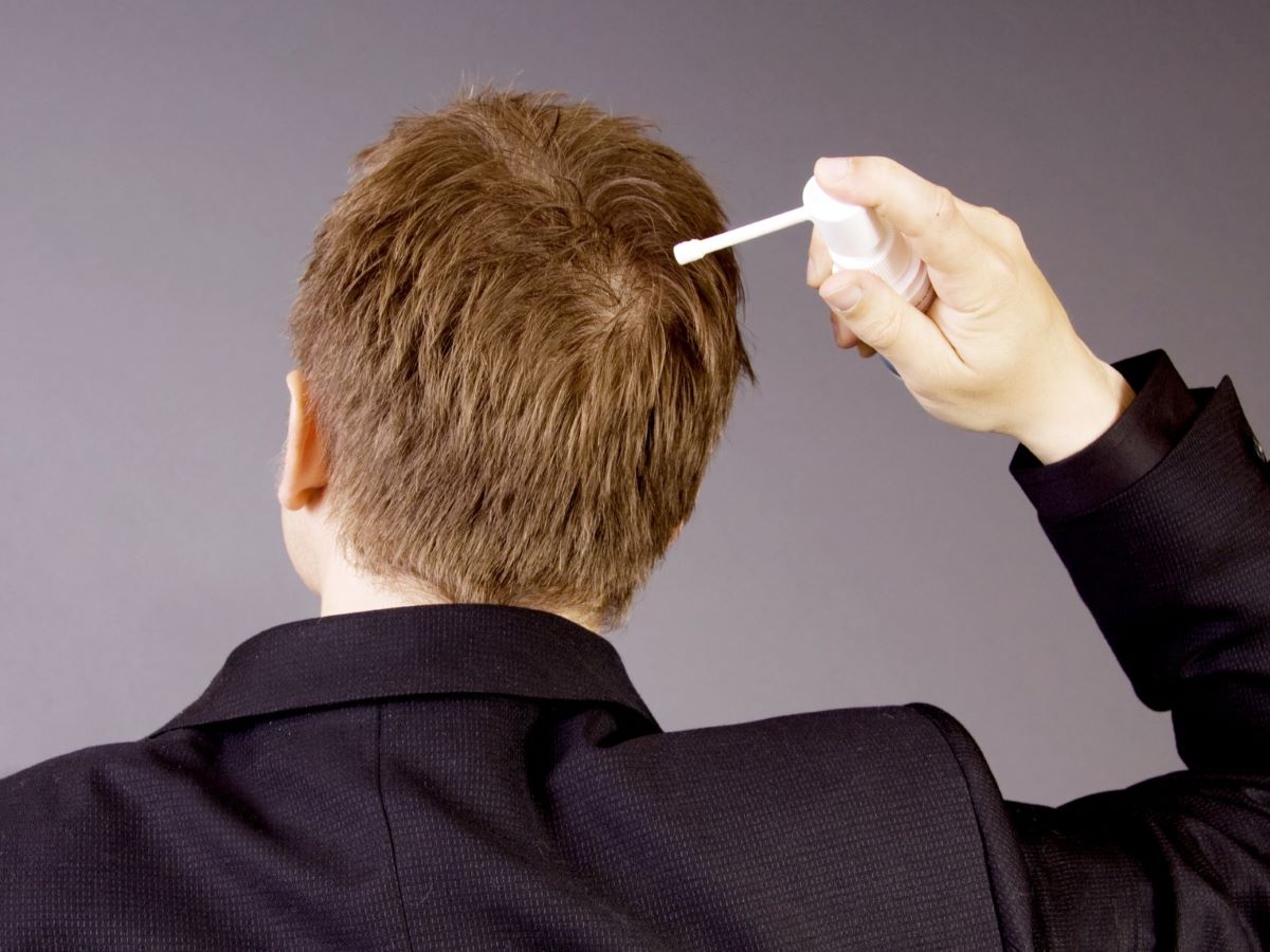 Man applying topical Finasteride to his scalp