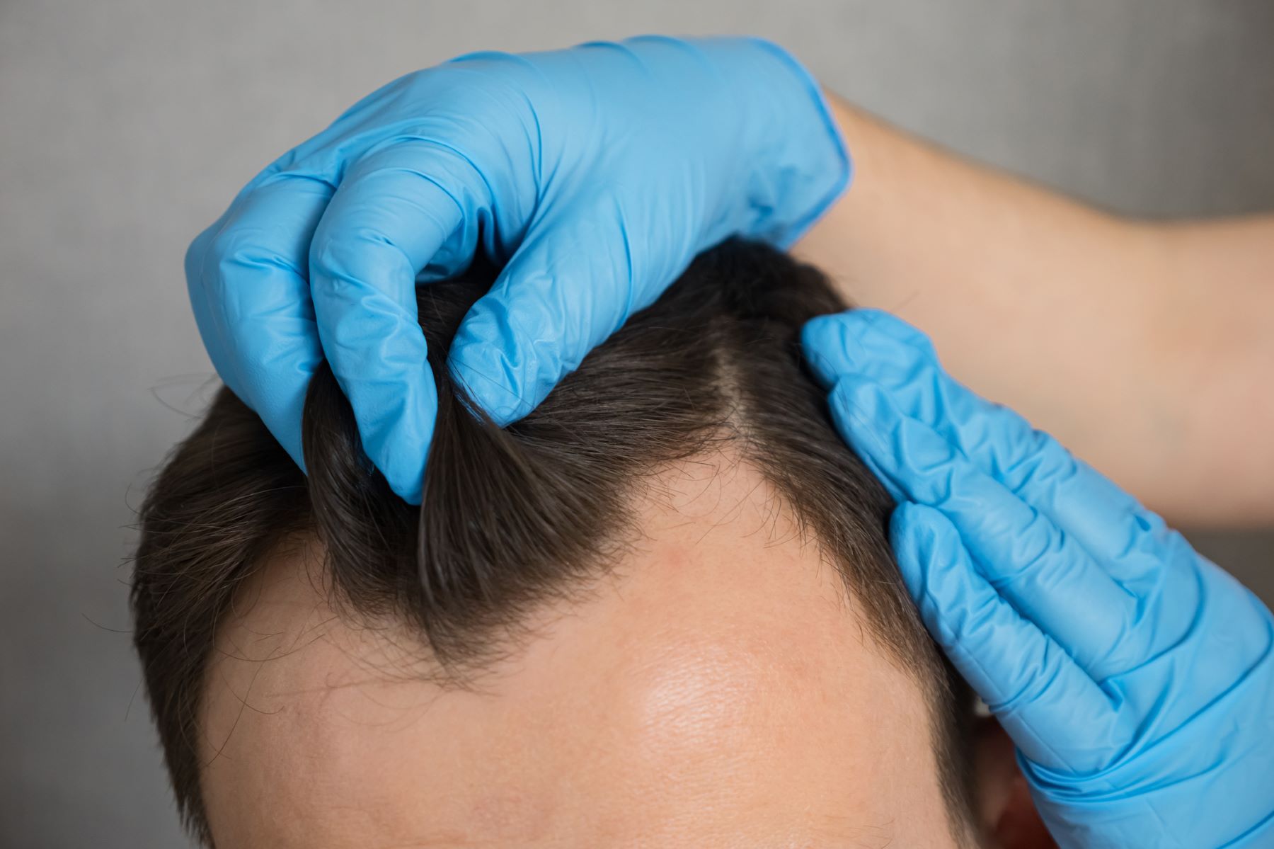 Man with a receding hairline