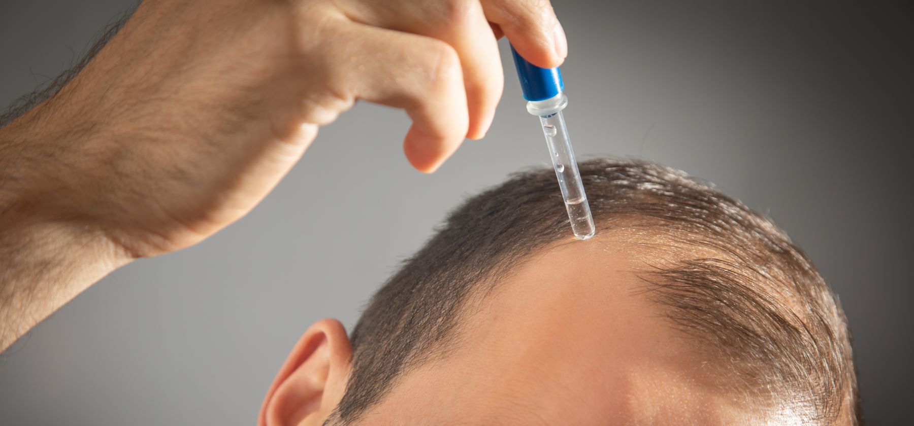 Minoxidil For A Receding Hairline: Benefits, Risks, Results