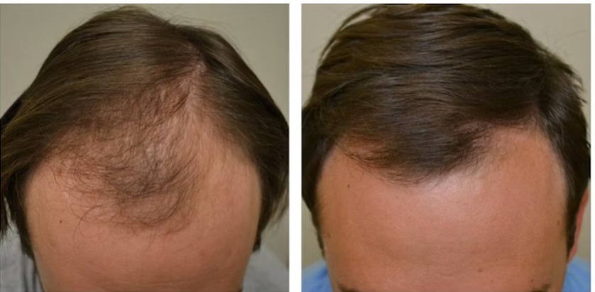 Minoxidil For A Receding Hairline: Benefits, Risks, Results