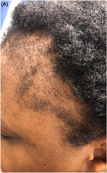 Receding hairline from traction alopecia