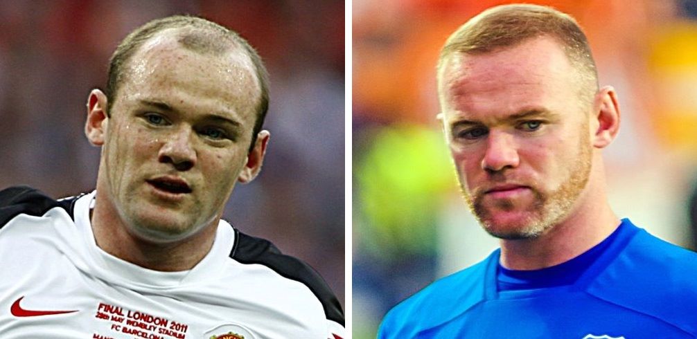 Wayne Rooney before and after hair transplant