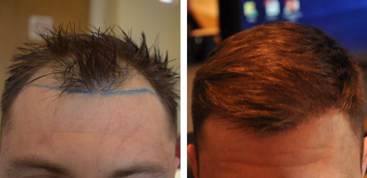 Wimpole Clinic hair transplant