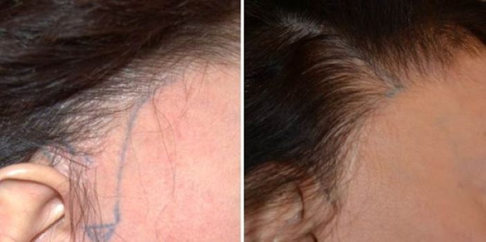 Wimpole Clinic patient before and 8 years after female hair transplant