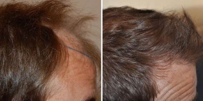 Wimpole Clinic patient before and nearly 7 years after frontal hairline hair transplant