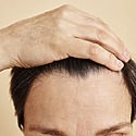 Frontal Balding: Causes, Symptoms, Treatments