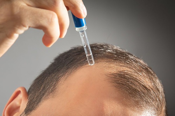 minoxidil for a receding hairline