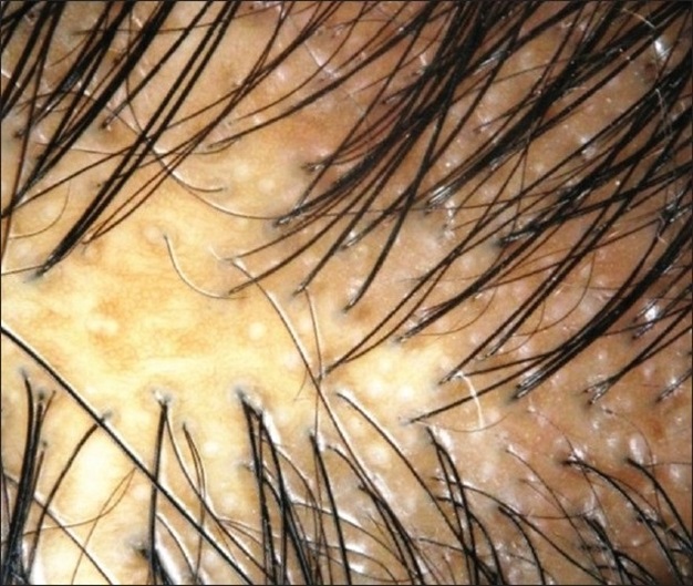 Dermoscopy picture of female pattern baldness