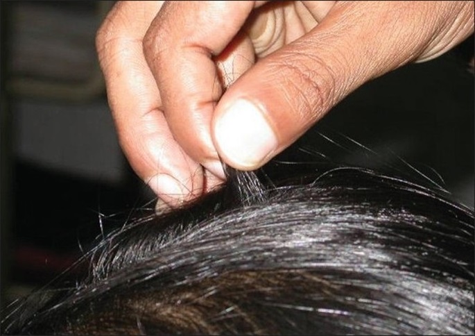 Doctor performing a hair pull test