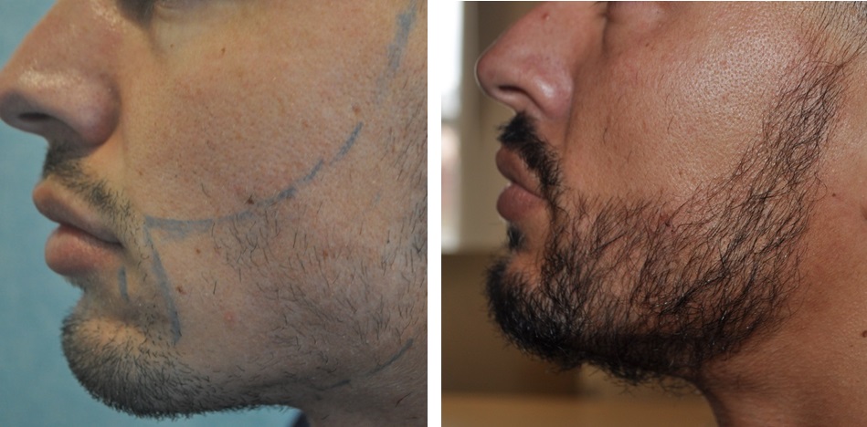 FUE beard transplant results after 8 months
