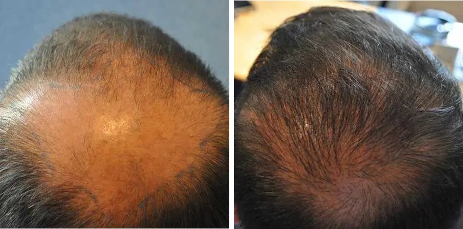 FUE crown hair transplant results after 22 months
