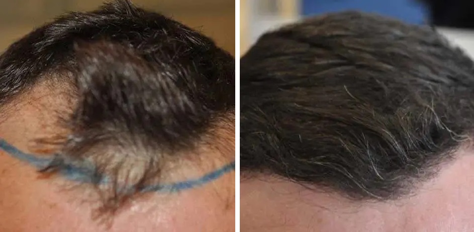 FUE hair transplant results after 8 months