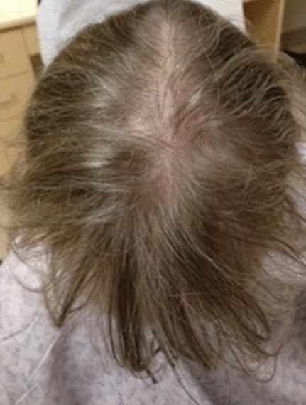 Lupus-induced hair loss